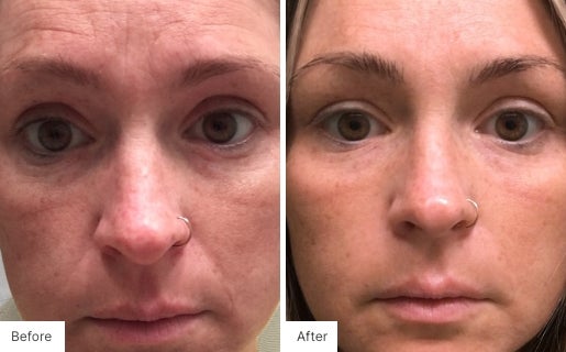 2 - Before and After Real Results photo of a woman's face.