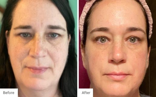 1 - Before and After Real Results photo of a woman's face.