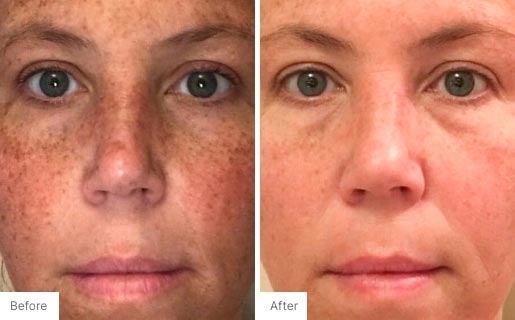 2 - Before and After Real Results photo of a woman's face.