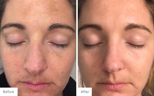 3 - Before and After Real Results photo of a woman's face.