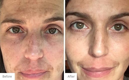 8 - Before and After Real Results photo of a woman's face.