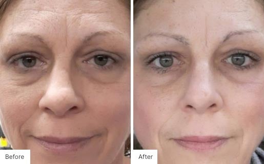 4 - Before and After Real Results image for Age IQ Night Cream