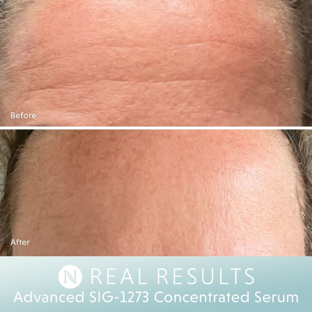 Sig Serum Real Results - Forehead shot