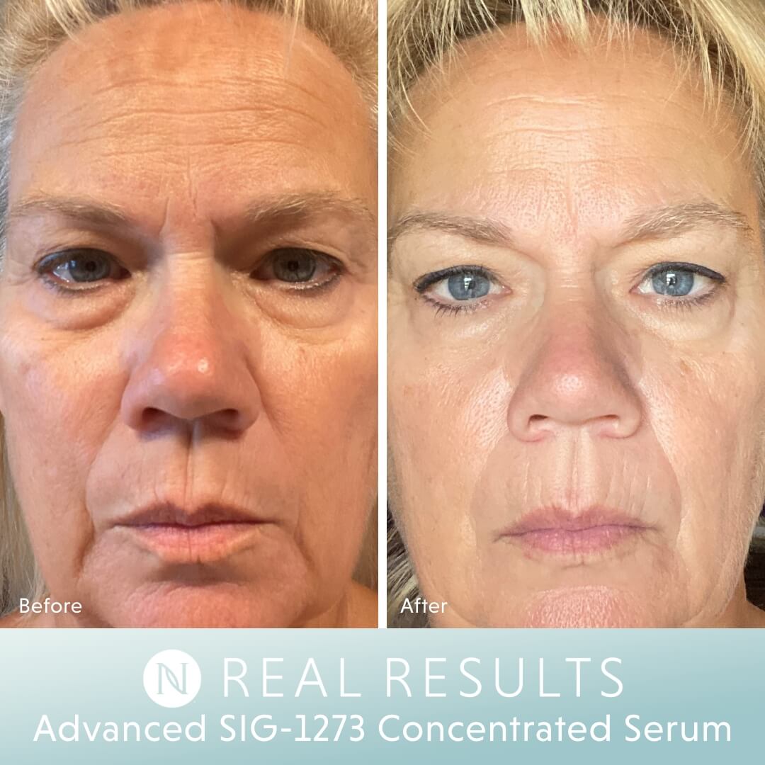 Sig Serum Real Results - Belinda